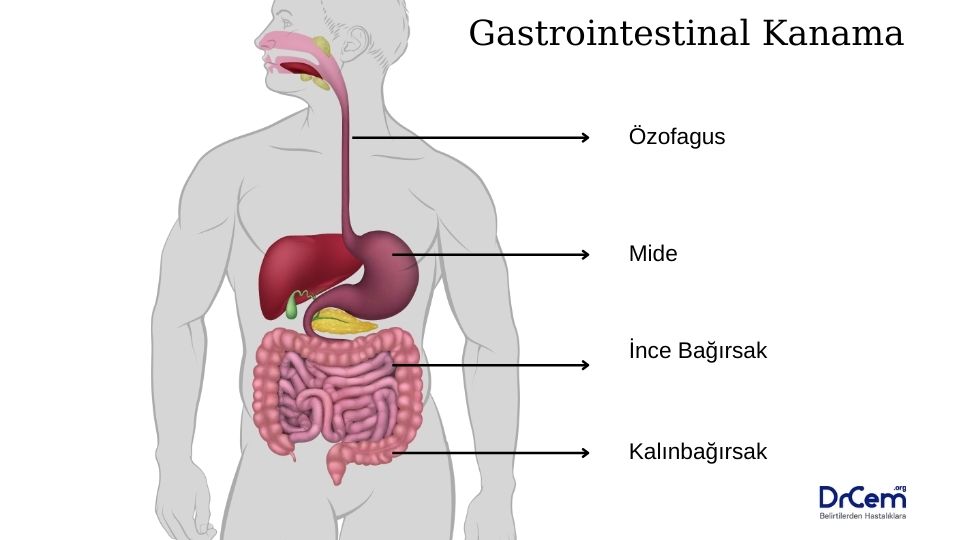 Gastrointestinal kanama görseli - DrCem hastalık rehberi